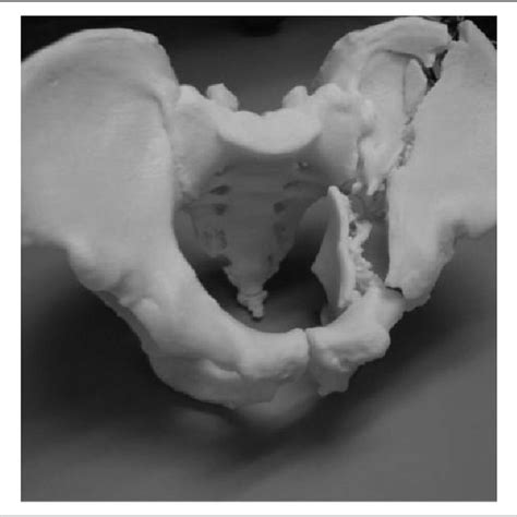 ct pelvis transverse film showed fracture left acetabulum  ct