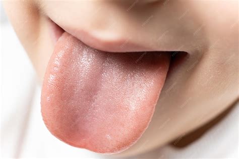 Crianca Com A Lingua Branca - A língua de uma criança saudável de seis anos com papilas na língua ...