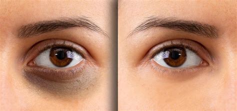 Under Eye Dark Circles Treatment in Dwarka, Delhi - Delhi Laser Clinic