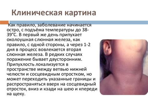 паротит