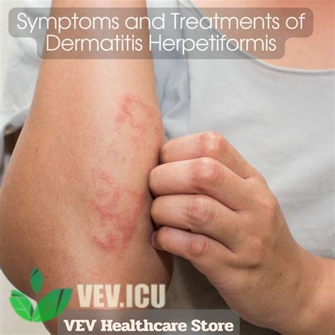 symptoms  treatments  dermatitis herpetiformis