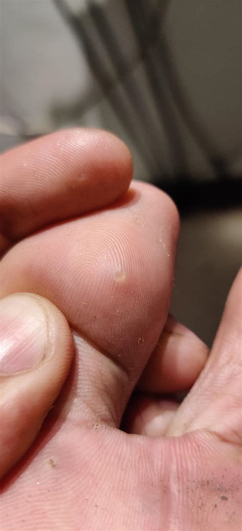 Small Bump On Sole Of Foot Factory Sale | emergencydentistry.com