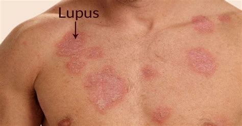 Lupus Da Direito A Aposentadoria - Aposentadoria por Lúpus: Direitos no INSS