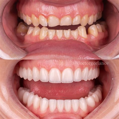 Veneer before and after – Artofit