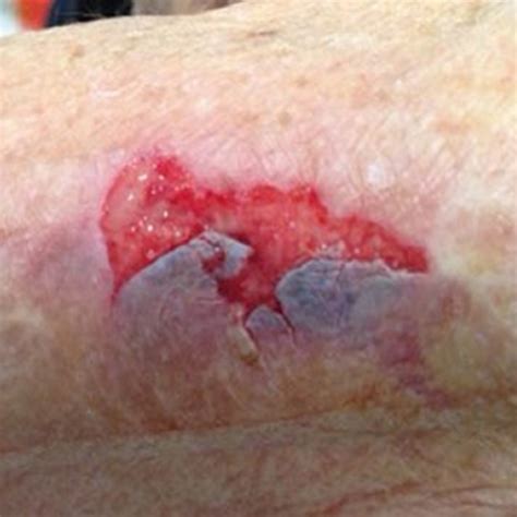 Tearing Of The Skin - What Causes Skin Tears And Bruising