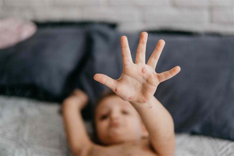 Chicken Pox Pictures Early Stages
