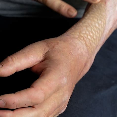 islande de la peau de poisson  greffer sur le corps des grands