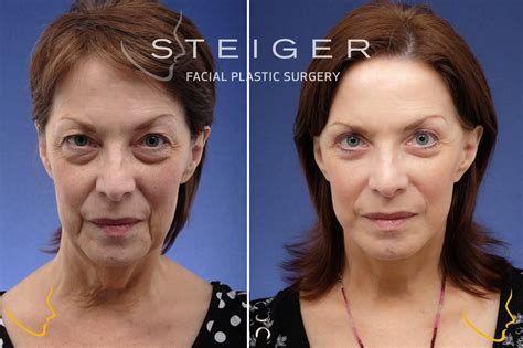facelift facelift utbh