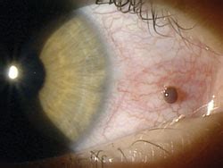 Conjunctival Foreign Body