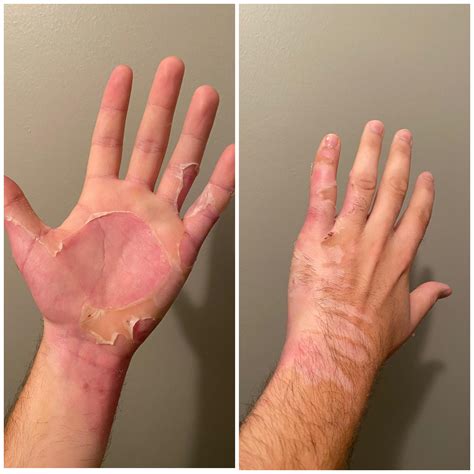 1055 best r/peeling images on Pholder | Peeled skin off lip