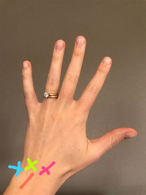 Hand Pain Ulnar Side at Samantha Tomlinson blog