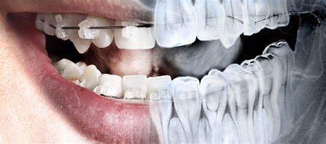 Oral Radiology - Common Types Of Intraoral Radiograph | GetDoc Says