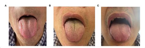 FIGURE E Diierent tongue-coating images of the three groups. (A) Thick... | Download Scientific ...