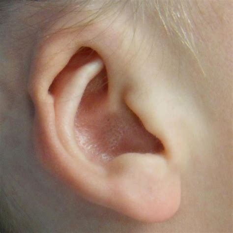 dronganlar baby ear molding cryptotia ear deformities  newborn