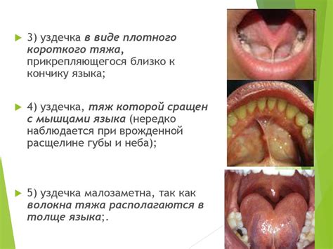 Виды уздечек. Показания к пластике уздечке языка - презентация онлайн