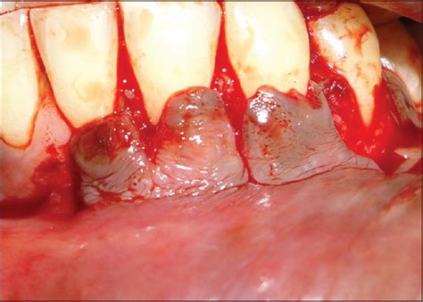 “United Pedicle Flap” for management of multiple gingival recessions - PMC