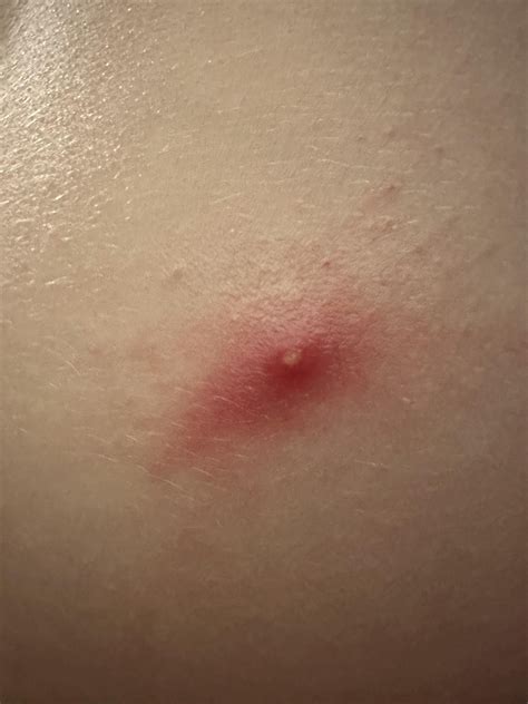 Spider/bug bite or Pimple? : r/bugbites