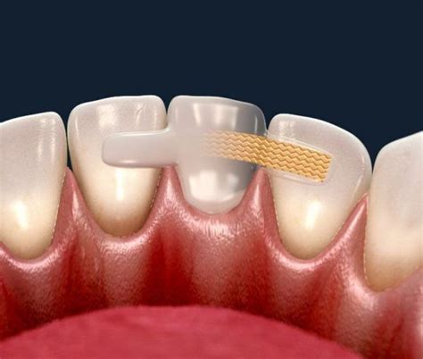 fibre reinforced dental bridge artofit