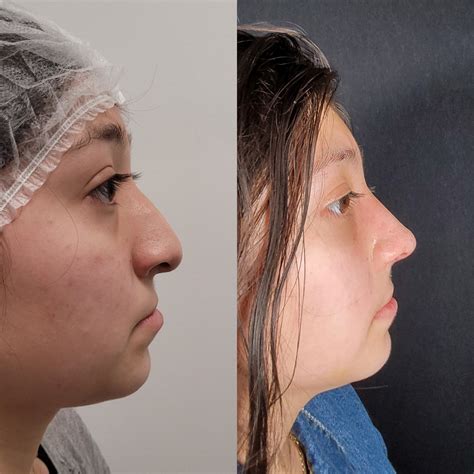 SUCCESS STORIES - Guerrero Plastic Surgery