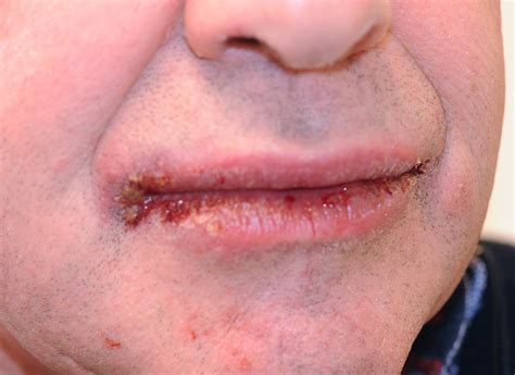 Toothpaste Burn Inside Mouth at William Gainey blog