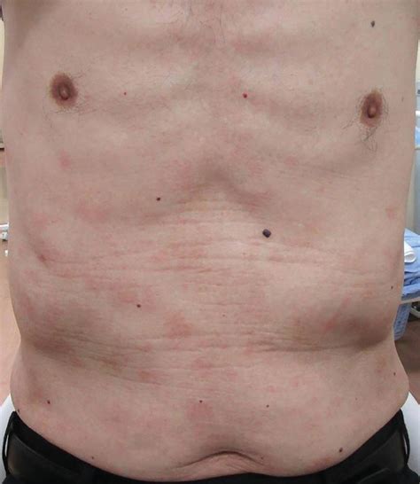 Mild Petechiae Arms