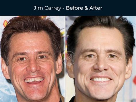 26 Celebrity Dental Implants and Veneers Before and After Photos - oggsync.com