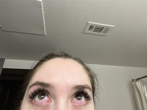is this chemical burn or allergic reaction? : r/eyelashextensions