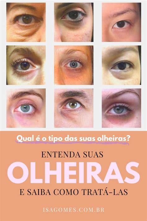 O Que São As Olheiras - Tudo Sobre Olheiras – O Que É Olheiras Na Pele – RKIF
