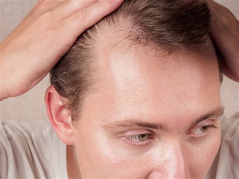 The haircut for balding widows peak that celebrities use to hide age 17