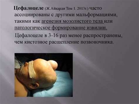 Черепно - мозговые грыжи у детей - презентация онлайн