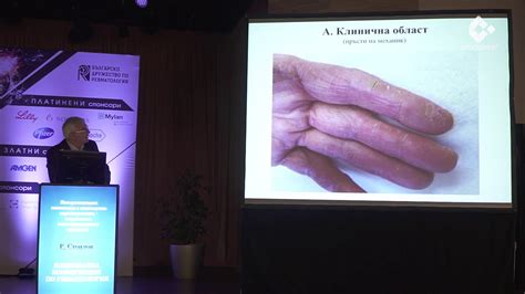 Интерстициална пневмония с авноимунна характеристика - съвременни ...