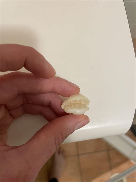 Can anyone tell me the name of this kind of splint? My sister tells me