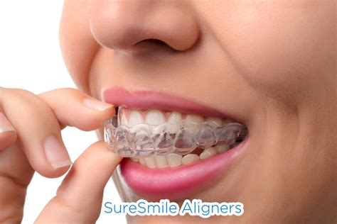 Suresmile Aligners