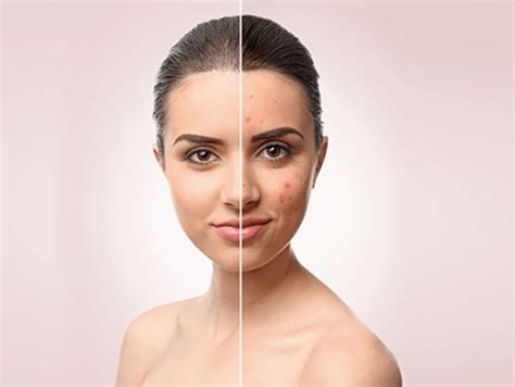 Peels – Skin by Design