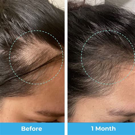 Hair Loss Vitamins: What You Need to Know - Hunter Games Magazine