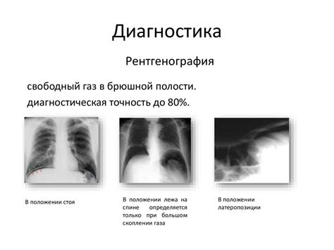 Перфорация язвы желудка и двенадцатиперстной кишки - презентация онлайн