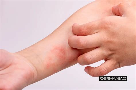 Dermatitis Atópica En La Cara Dermatitis Atópica Como Cuidar La Piel