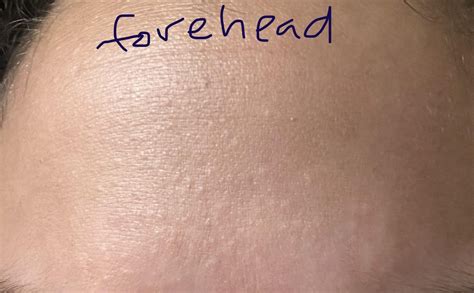 [Skin Concerns] Stubborn closed comedones even after chemical ...