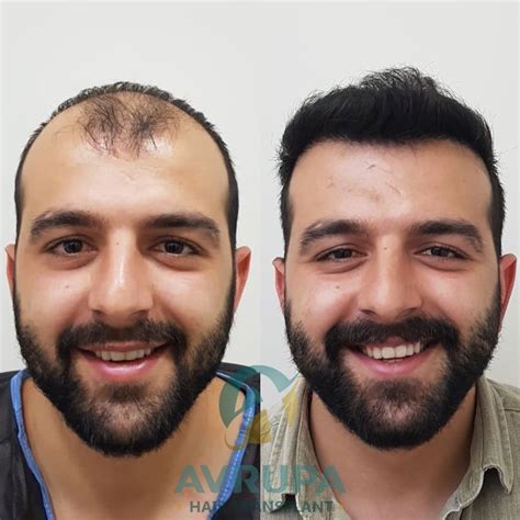 Hair transplant turkey – Artofit
