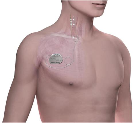 | The stimulation system consists of an implantable pulse generator