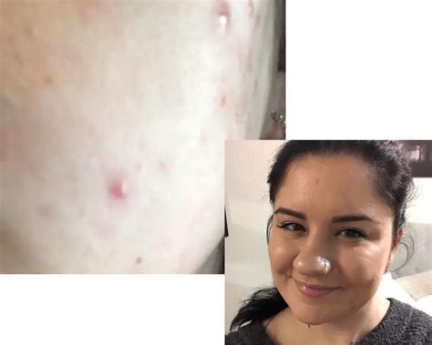 Shaving My Face Ruined My Life | 3 Cases (Experiences) - Blushastic