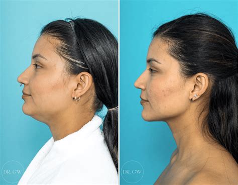 Effective Solutions for Eliminating Unwanted Skin Under Your Chin: A Simple Guide - Hunter Games Magazine