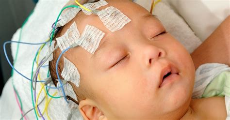 Is it Infantile Spasms? - Infantile Spasms Action Network