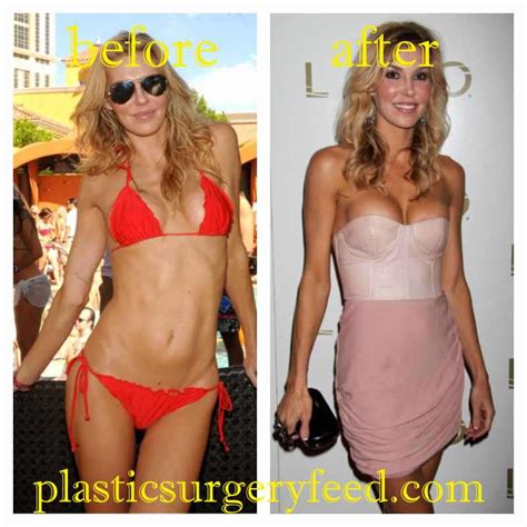 Brandi Glanville Plastic Surgery - Plastic Surgery Feed