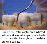 The Versatility of the Universal Curet - Dimensions of Dental Hygiene