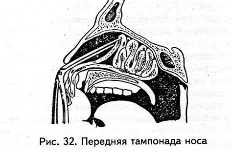 9. Техника выполнения передней тампонады носа.