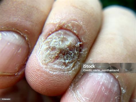 Bicho Na Unha Da Mão - Foto de Grande Perto Do Fungo Infecção Na Mão De Unhas Dedo Com ...