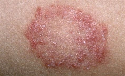 fungal infection  skin venkat center  aesthetic health