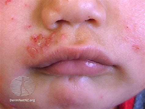 skin ulcer  face