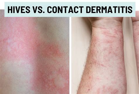 Hives (Urticaria) vs. Rash: Pictures and Differences